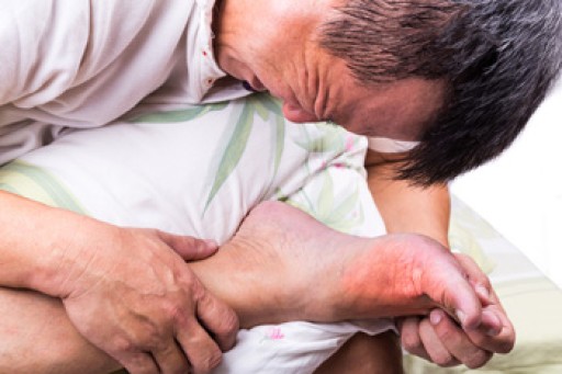 Everything You Need to Know About Gout