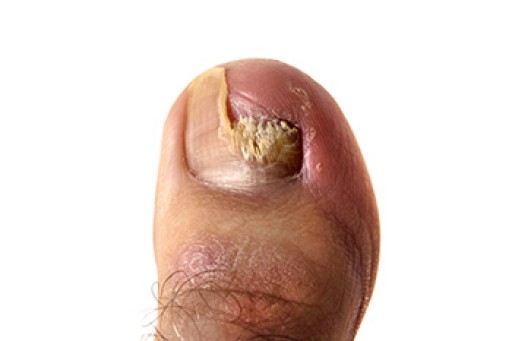 Toenail Fungus