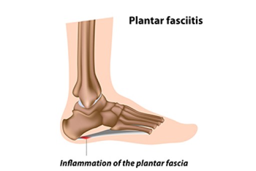 Symptoms of Plantar Fasciitis