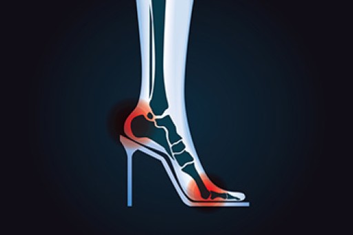 Effect of High Heels on the Feet