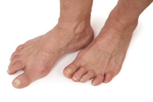 Rheumatoid Arthritis in the Feet